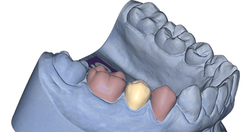 exocad Provisional (Perpetual Initial Purchase)
